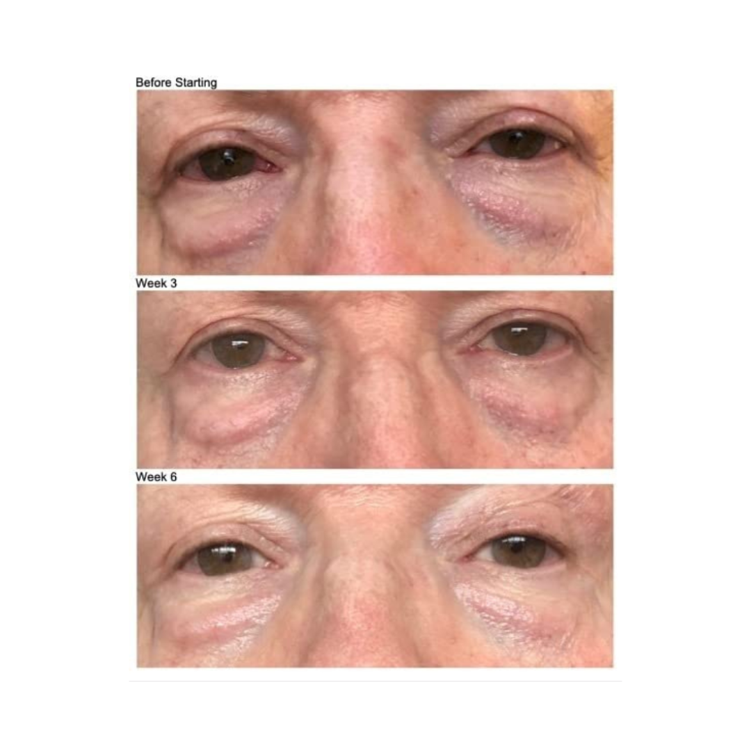 Before and after using Kleem Organics Firming Eye Cream – visible reduction in under-eye puffiness and dark circles
