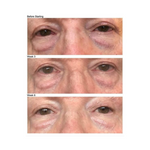 Before and after using Kleem Organics Firming Eye Cream – visible reduction in under-eye puffiness and dark circles
