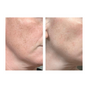 Kleem Dark Spot Serum before and after of a client that struggled with hyperpigmentation and uneven skin tone. The results reduced dark spots and even skin tone