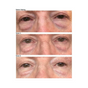 Before and after using Kleem Organics Firming Eye Cream – visible reduction in under-eye puffiness and dark circles