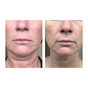 Kleem Organics Neck & Décolleté Firming Cream before and after showing reduced wrinkles, improved skin texture being more firm and elastic