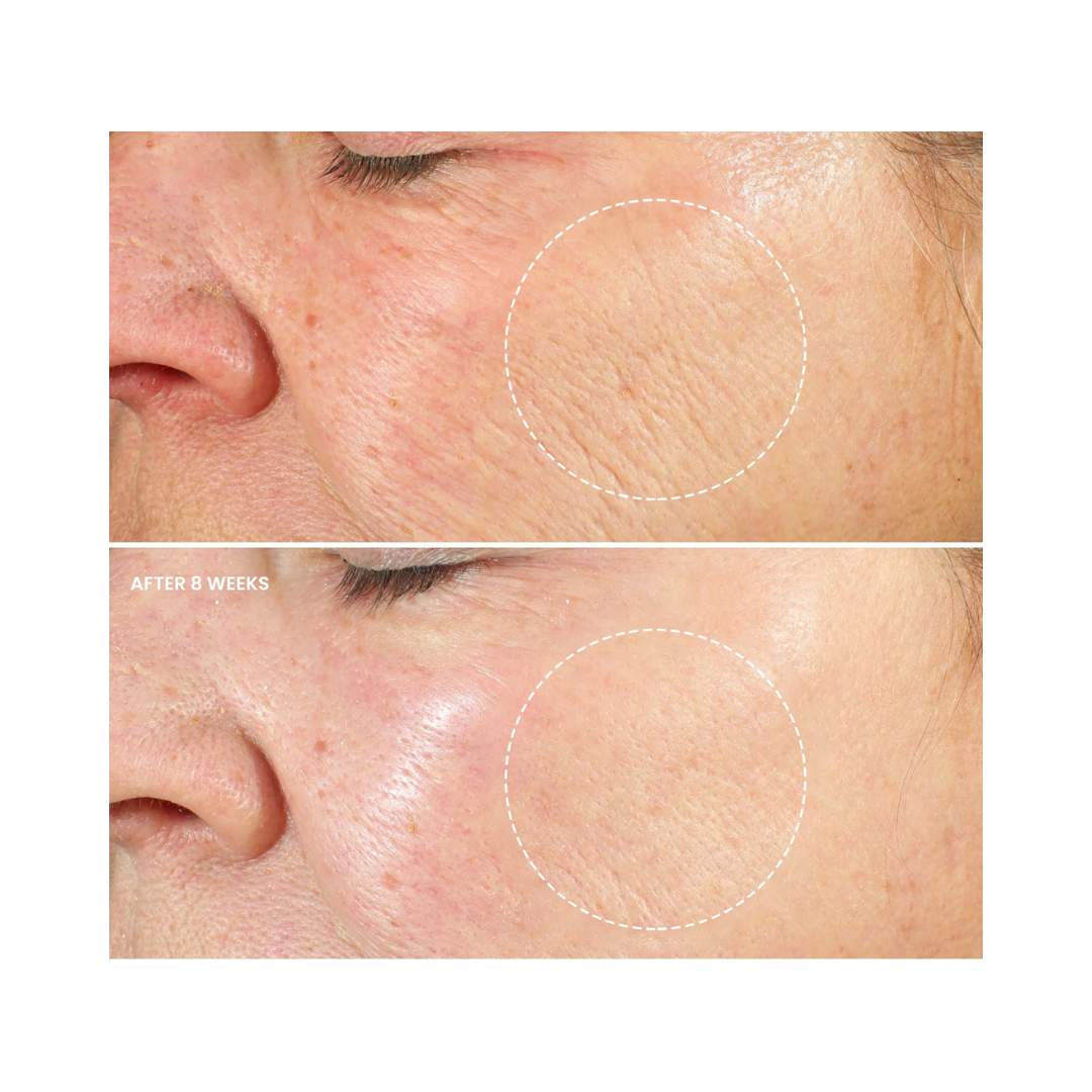 Kleem Organics Retinol Night Cream before and after sowing reduced wrinkles, improved skin texture being more firm and elastic