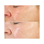 Kleem Organics Retinol Night Cream before and after sowing reduced wrinkles, improved skin texture being more firm and elastic