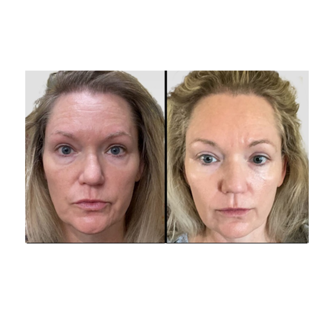 Kleem Niacinamide Booster before and after of a client that struggled with dull, uneven skin and hyprpigmentation. The results clear, smoother and brighter skin, healthier complexion, boost of radiance
