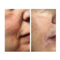 Kleem Peptide Complex Booster before and after of a client that struggled with fine lines and wrinkles. The results smooth and replenished skin, enhanced elasticity