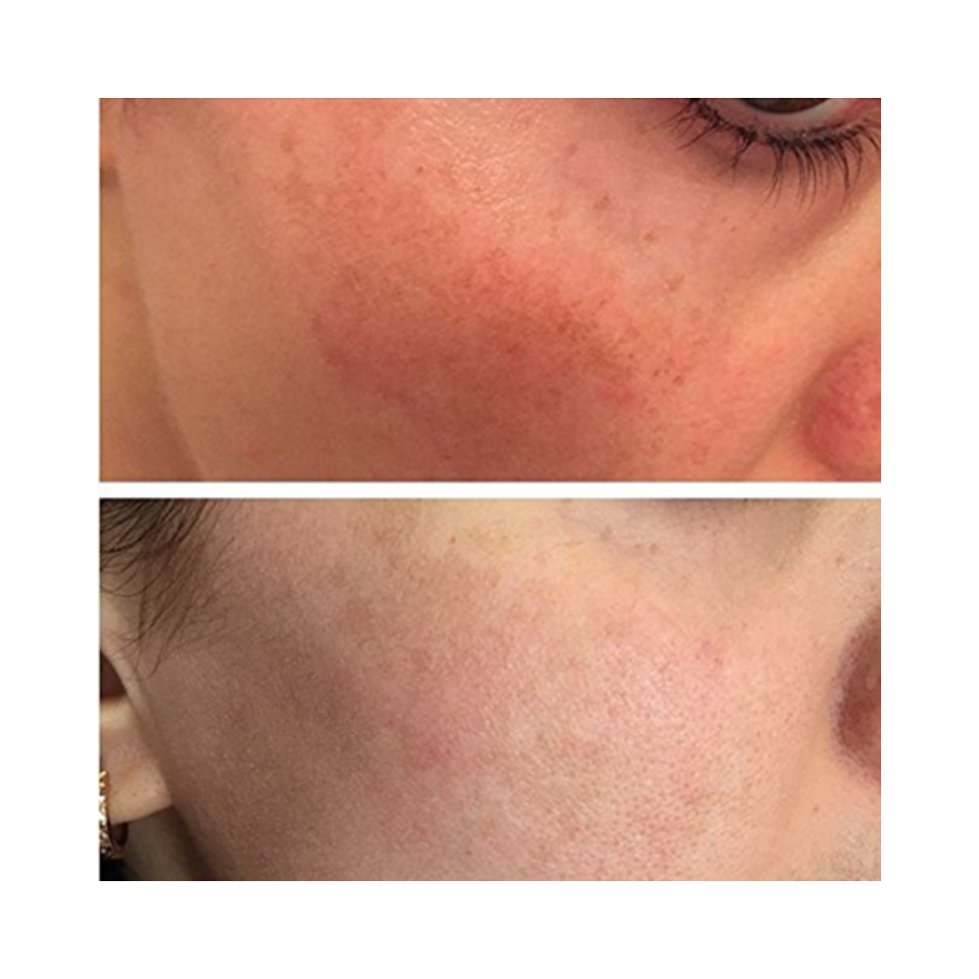 Kleem Organics Vitamin C Serum before and after of a client that struggled with redness and uneven skin tone. The results smoother complexion and no redness anymore